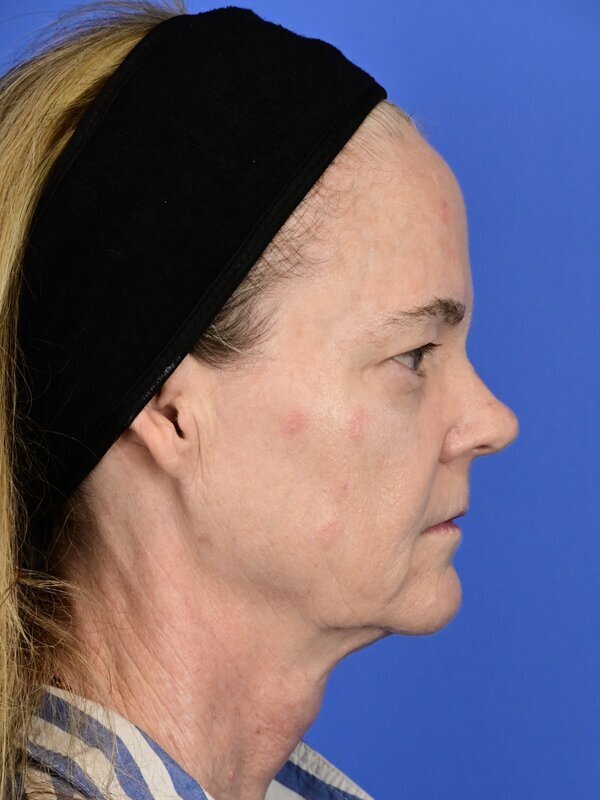 Face & Neck Lift Before & After Image
