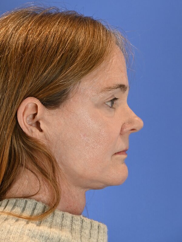 Face & Neck Lift Before & After Image