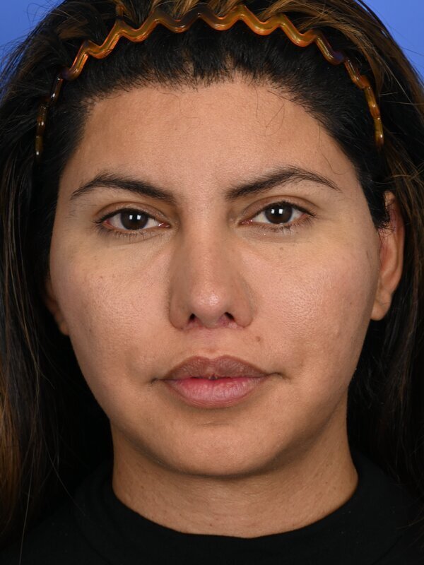 Face & Neck Lift Before & After Image
