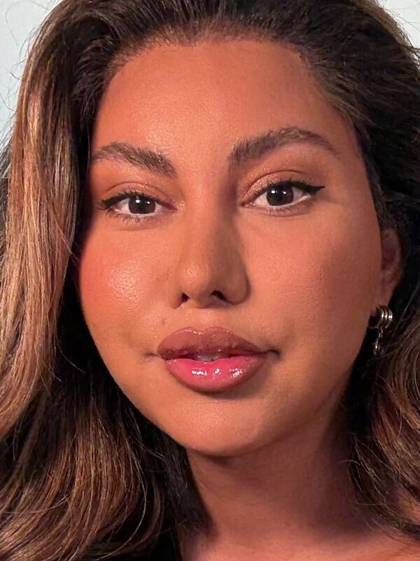 Face & Neck Lift Before & After Image