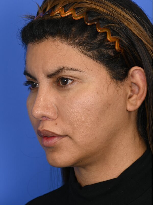 Face & Neck Lift Before & After Image