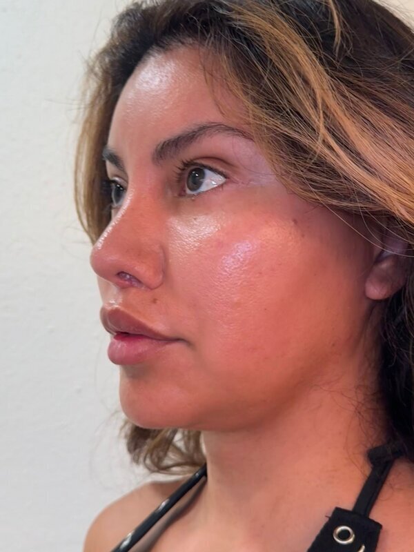 Face & Neck Lift Before & After Image