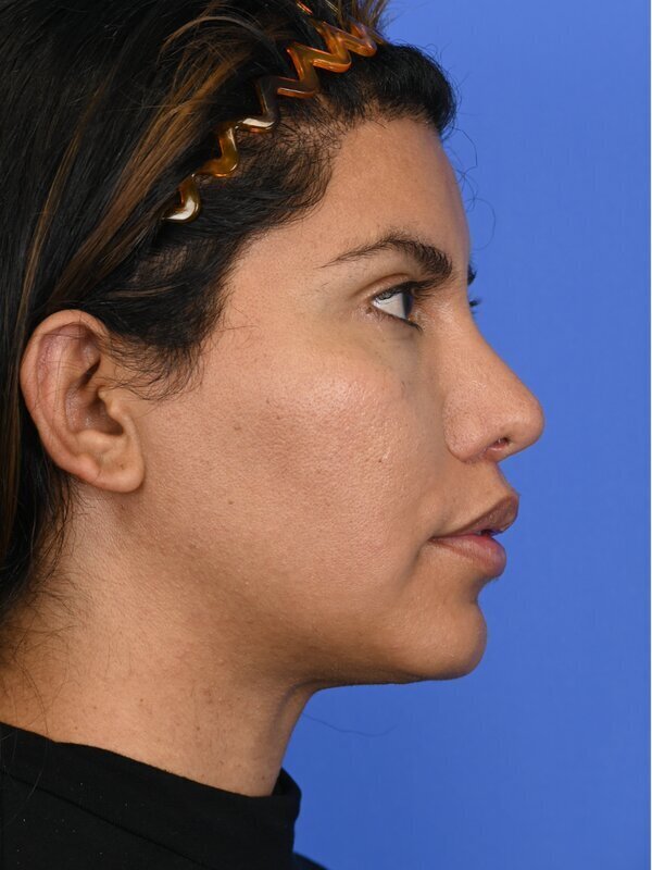 Face & Neck Lift Before & After Image