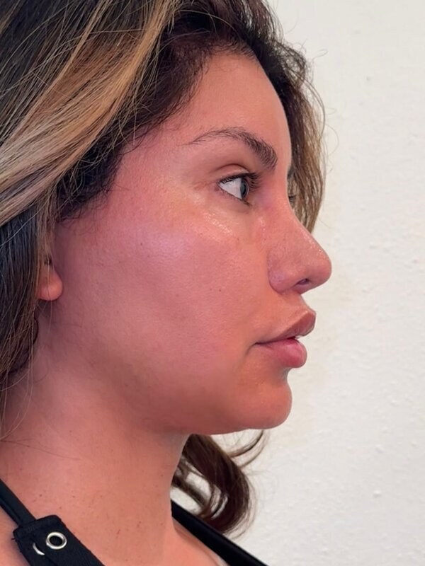 Face & Neck Lift Before & After Image