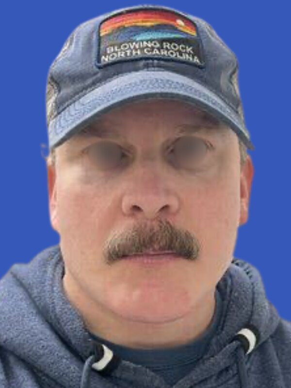 Face & Neck Lift Before & After Image