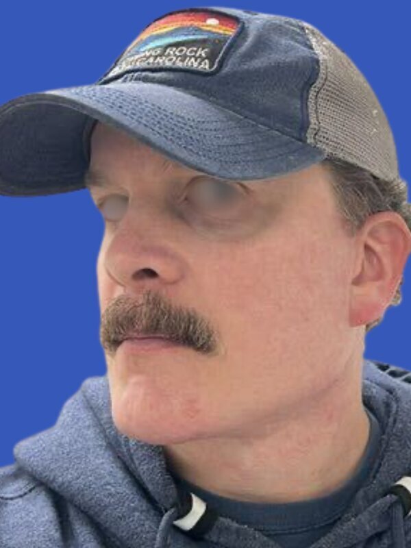 Face & Neck Lift Before & After Image