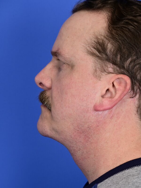 Face & Neck Lift Before & After Image