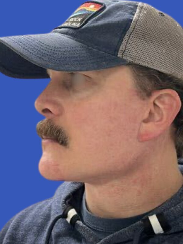 Face & Neck Lift Before & After Image