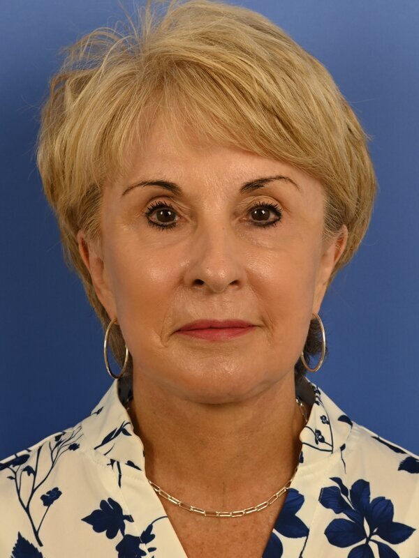 Face & Neck Lift Before & After Image