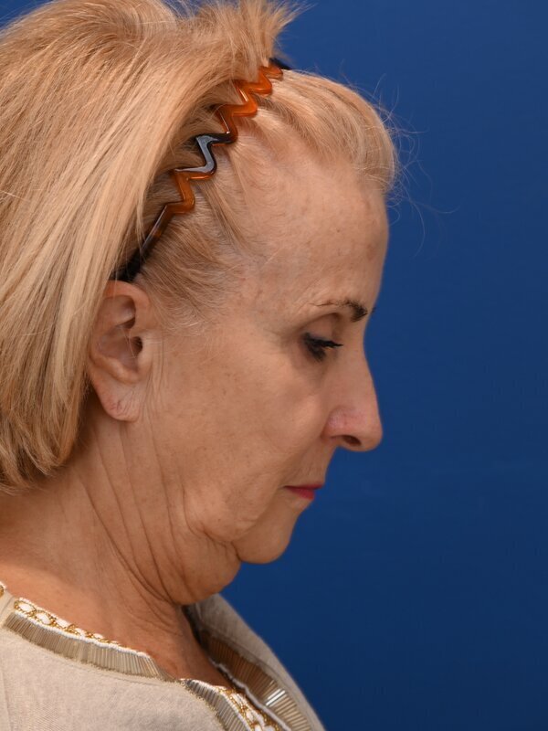 Face & Neck Lift Before & After Image