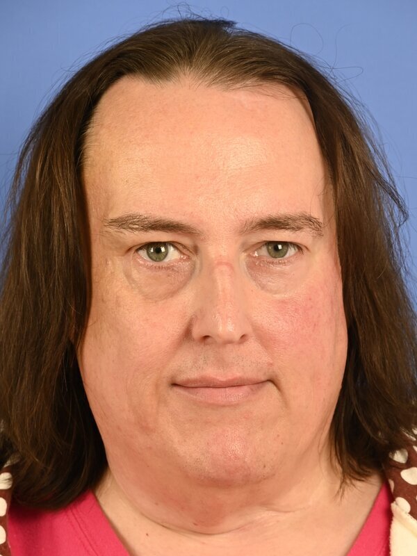 Face & Neck Lift Before & After Image