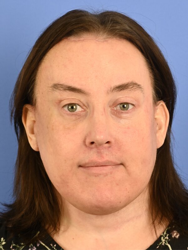 Face & Neck Lift Before & After Image
