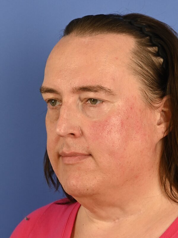 Face & Neck Lift Before & After Image