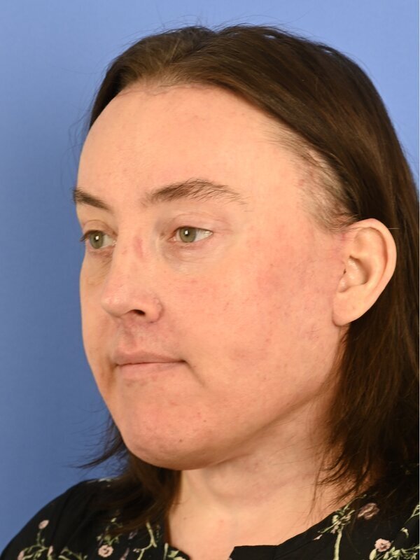 Face & Neck Lift Before & After Image