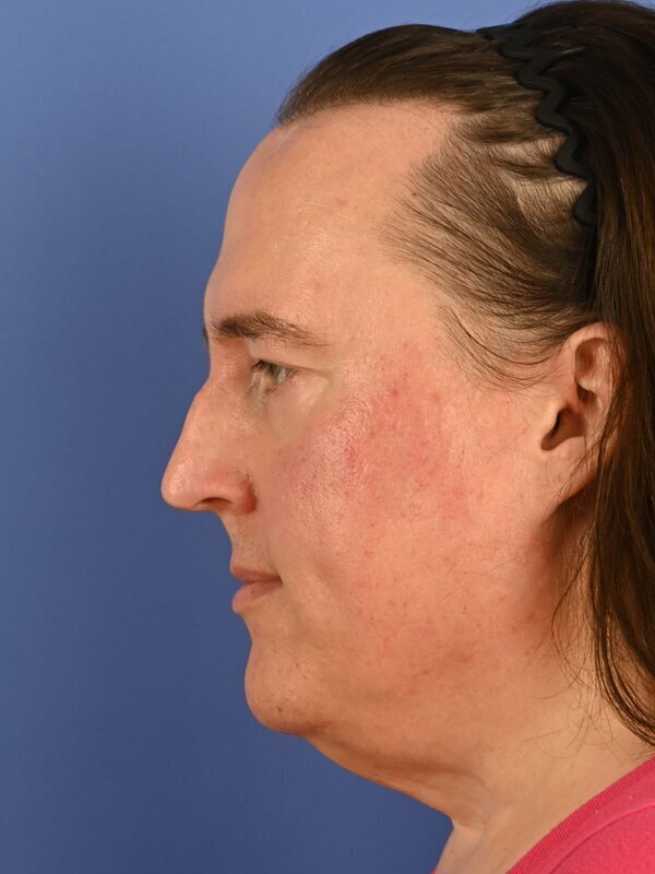 Face & Neck Lift Before & After Image