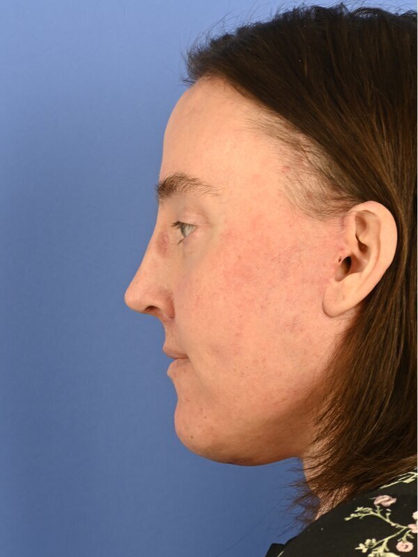 Face & Neck Lift Before & After Image