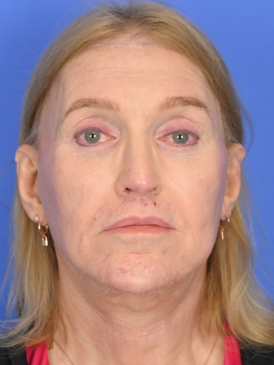 Facial Feminization Surgery Before & After Image