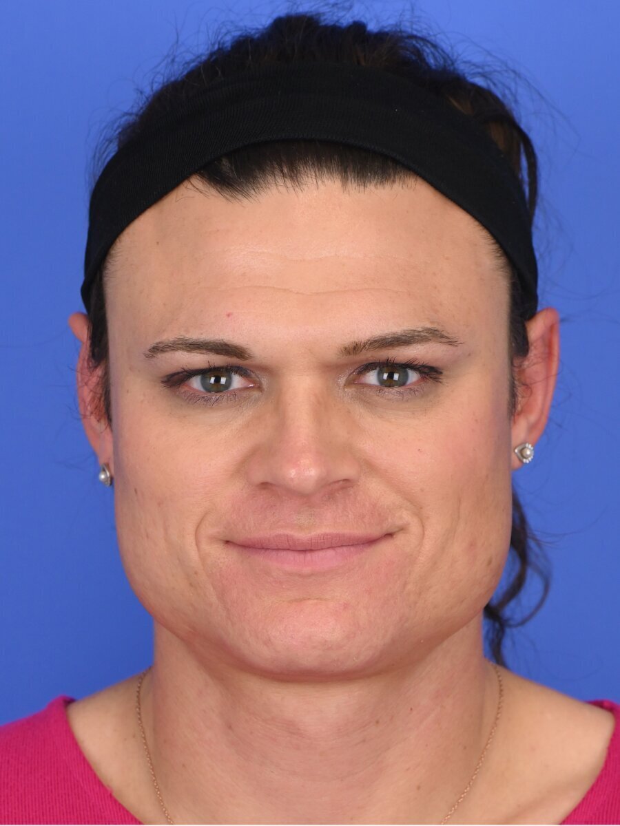 Facial Feminization Surgery Before & After Image
