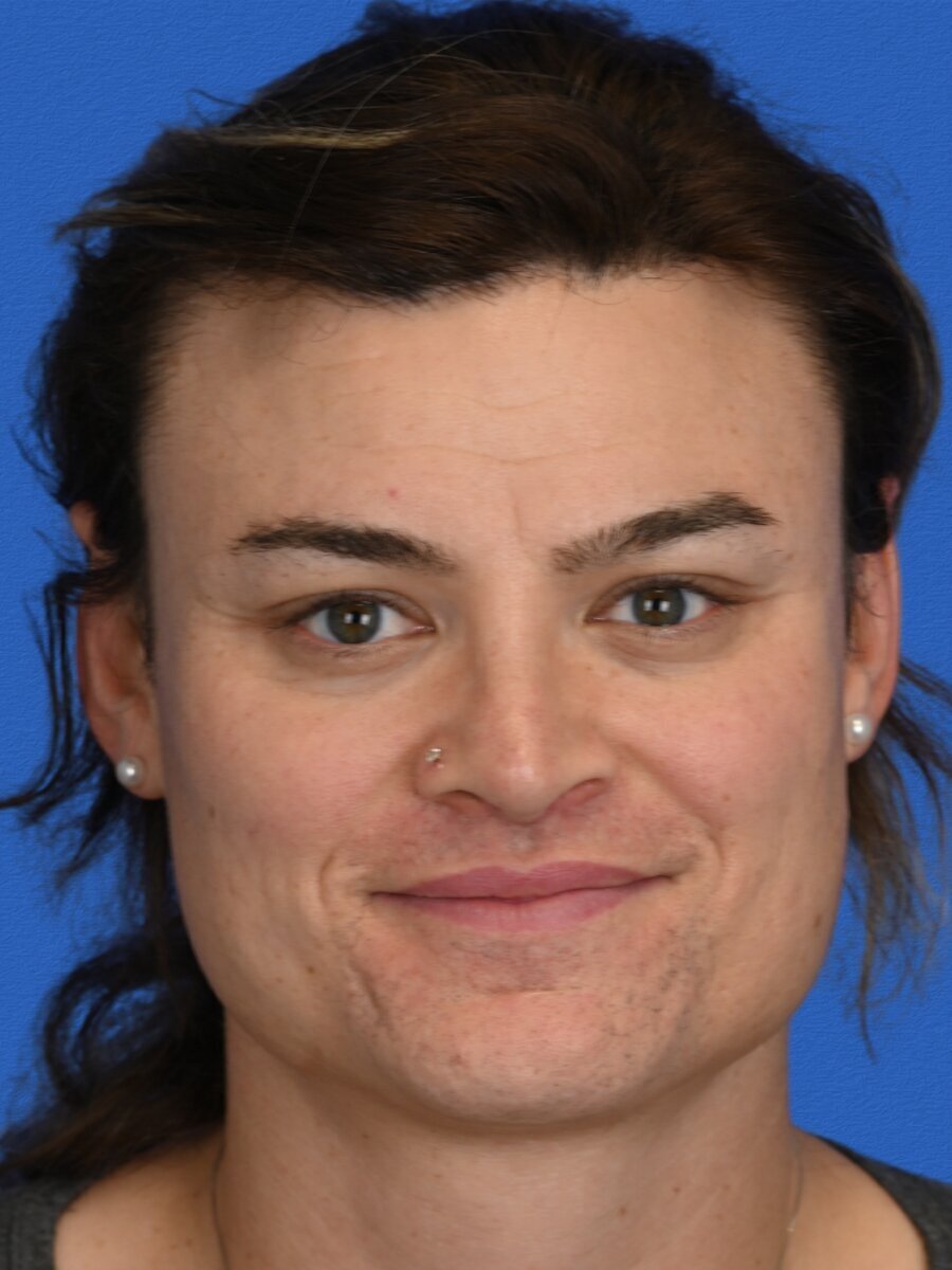 Facial Feminization Surgery Before & After Image