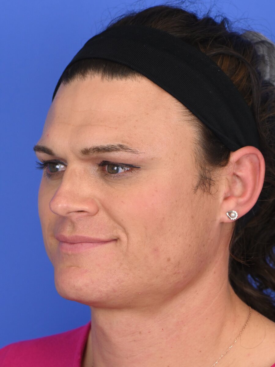 Facial Feminization Surgery Before & After Image
