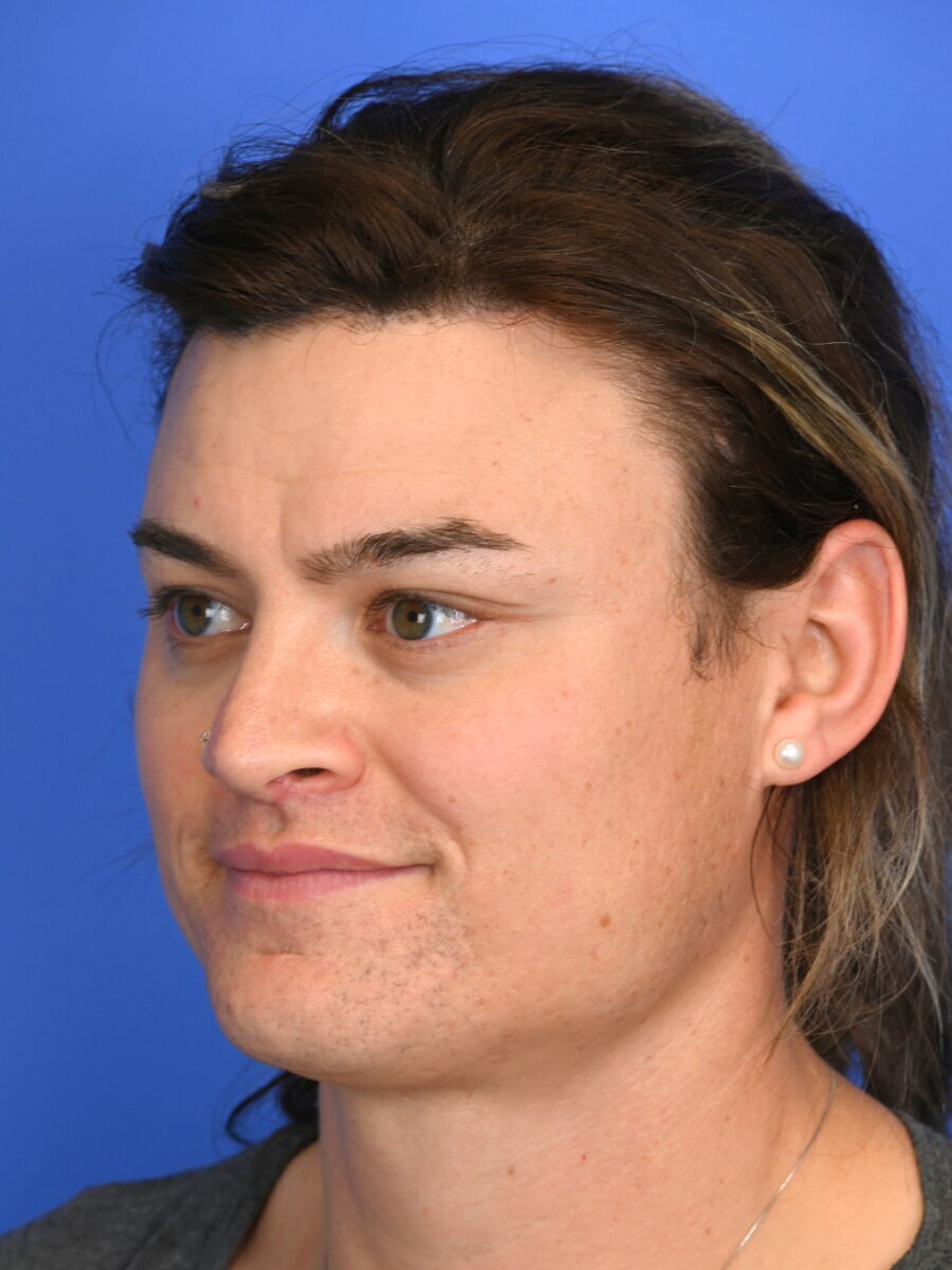 Facial Feminization Surgery Before & After Image