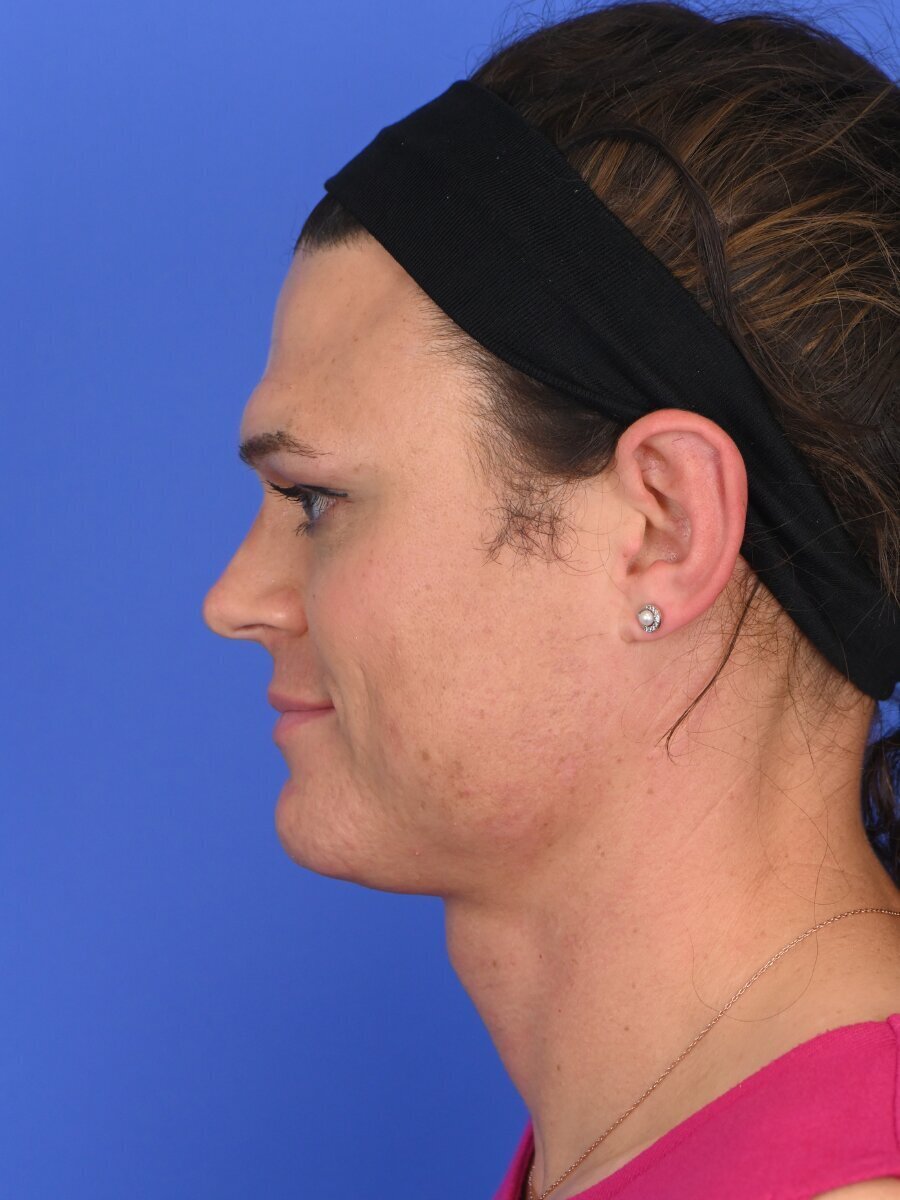 Facial Feminization Surgery Before & After Image