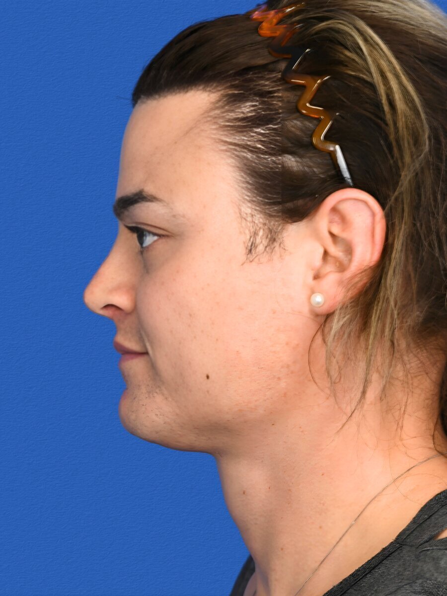 Facial Feminization Surgery Before & After Image