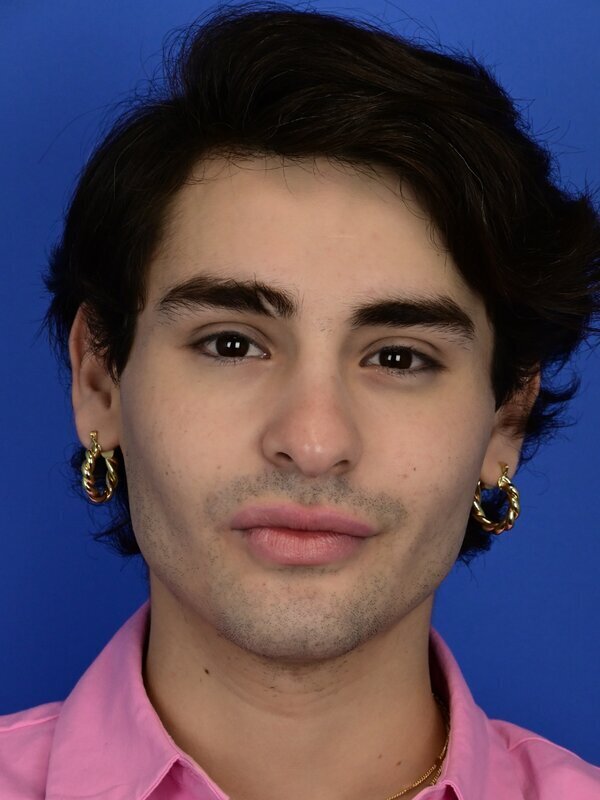 Facial Feminization Surgery Before & After Image