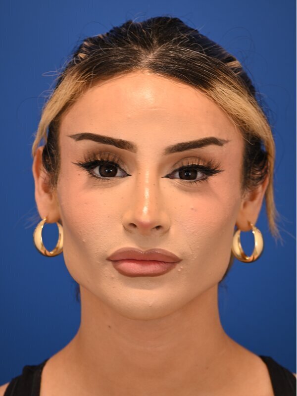 Facial Feminization Surgery Before & After Image