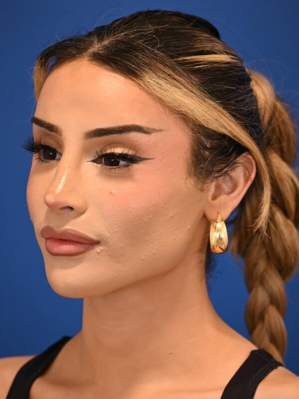 Facial Feminization Surgery Before & After Image