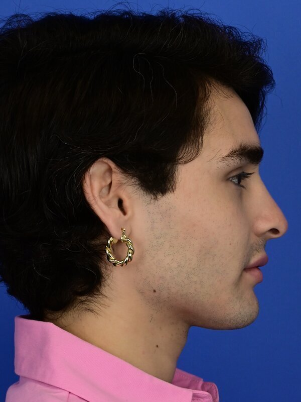 Facial Feminization Surgery Before & After Image
