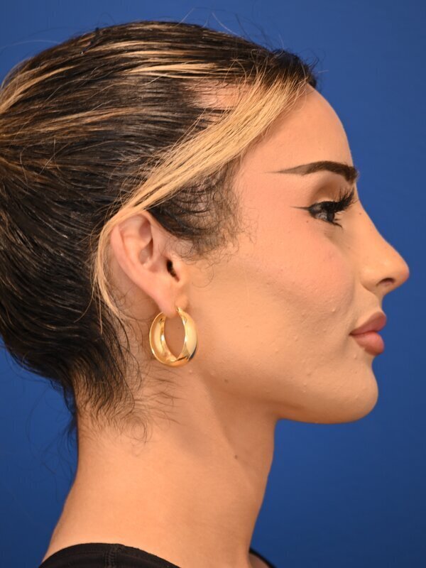 Facial Feminization Surgery Before & After Image