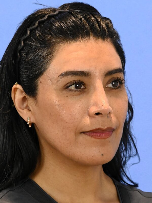 Facial Feminization Surgery Before & After Image