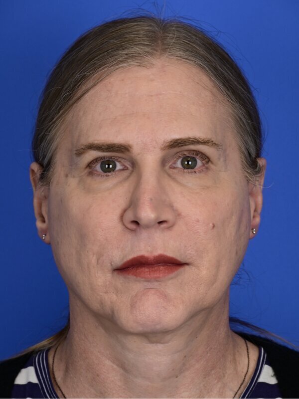 Facial Feminization Surgery Before & After Image