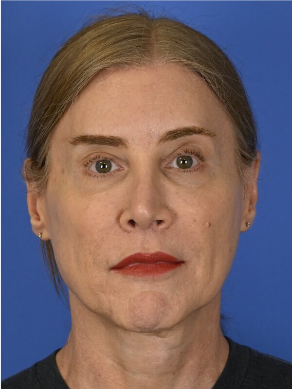 Facial Feminization Surgery Before & After Image
