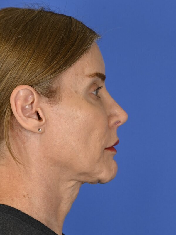 Facial Feminization Surgery Before & After Image