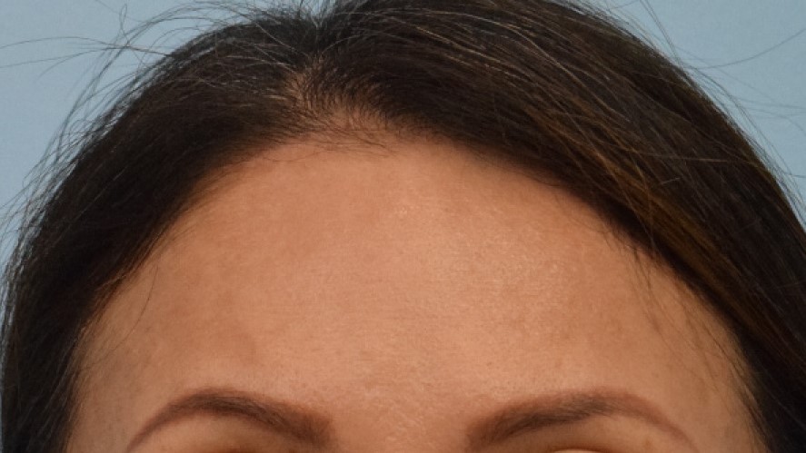 Facial Mass Removal Before & After Image