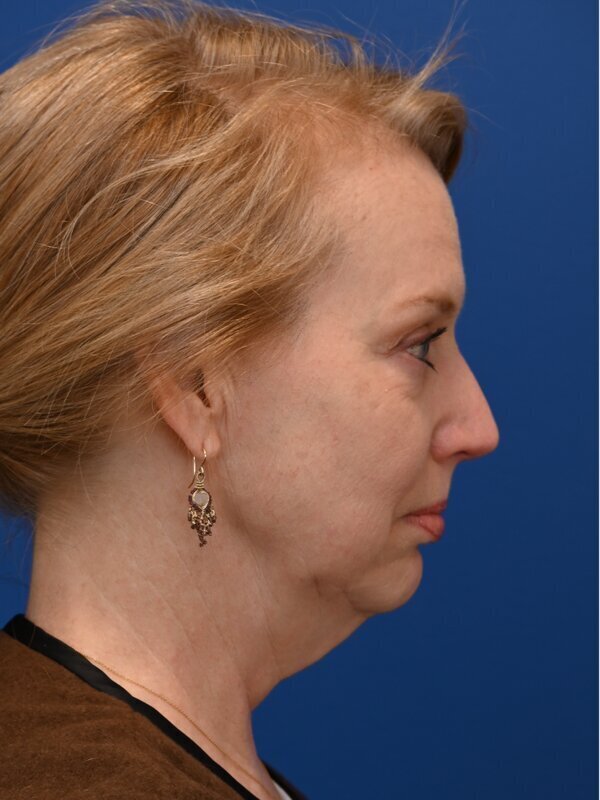 Forward Lift Before & After Image
