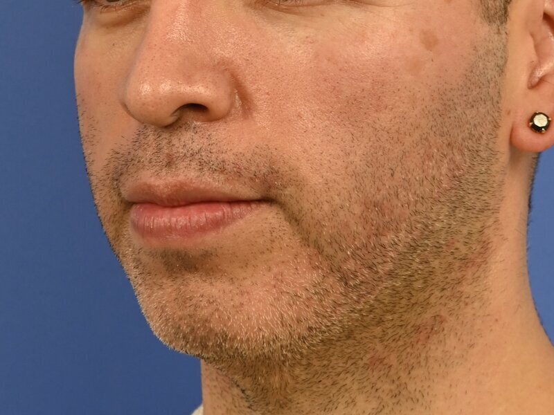 Male Facelift Before & After Image