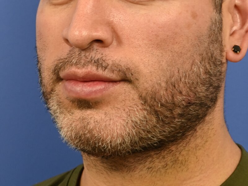 Male Facelift Before & After Image