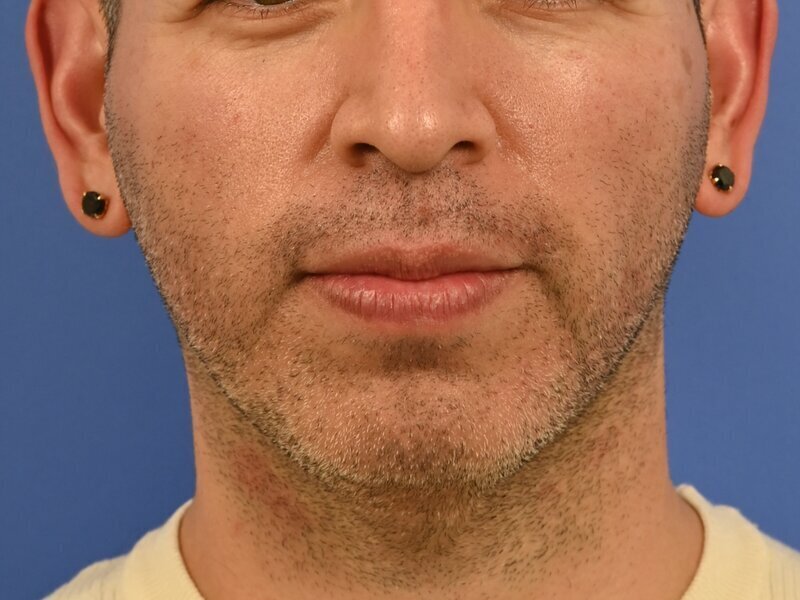Male Facelift Before & After Image