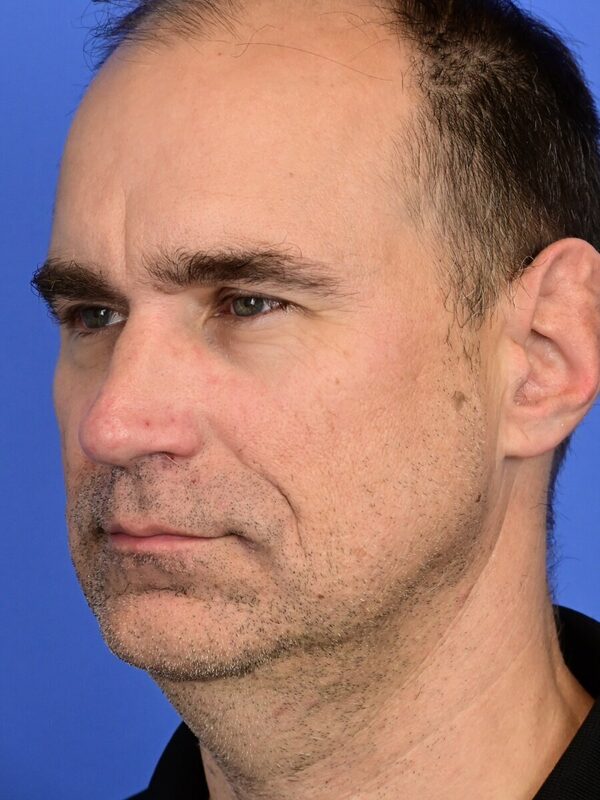 Male Facelift Before & After Image