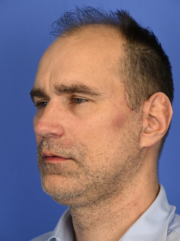 Male Facelift Before & After Image
