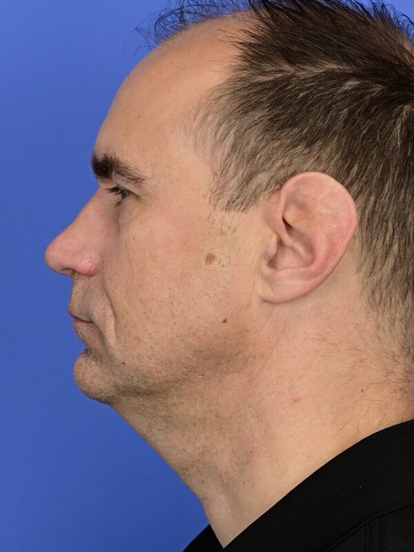 Male Facelift Before & After Image