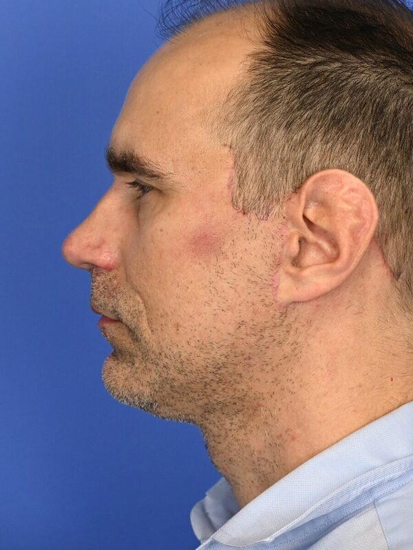 Male Facelift Before & After Image