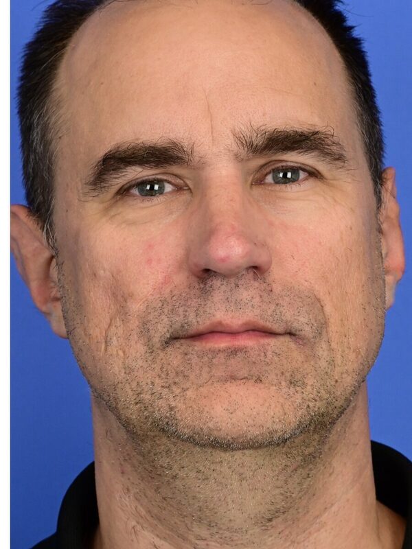 Male Facelift Before & After Image
