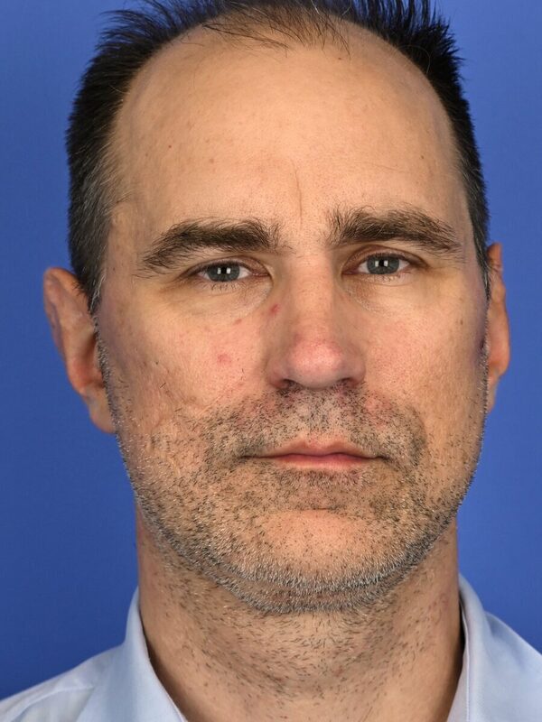 Male Facelift Before & After Image