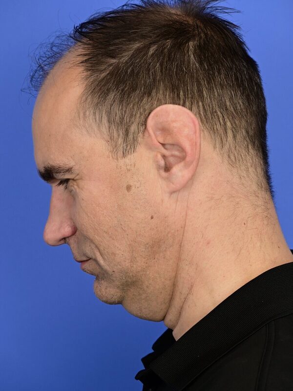 Male Facelift Before & After Image