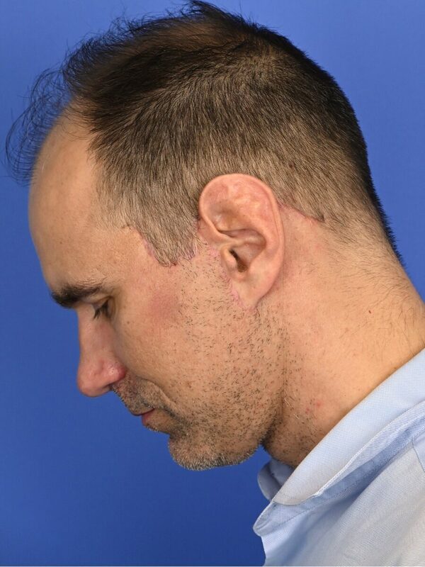 Male Facelift Before & After Image