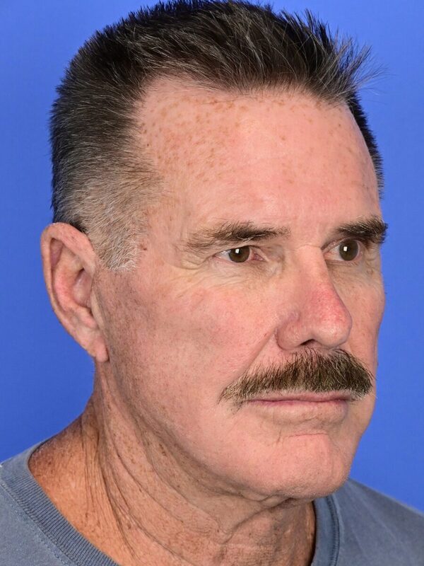 Male Facelift Before & After Image